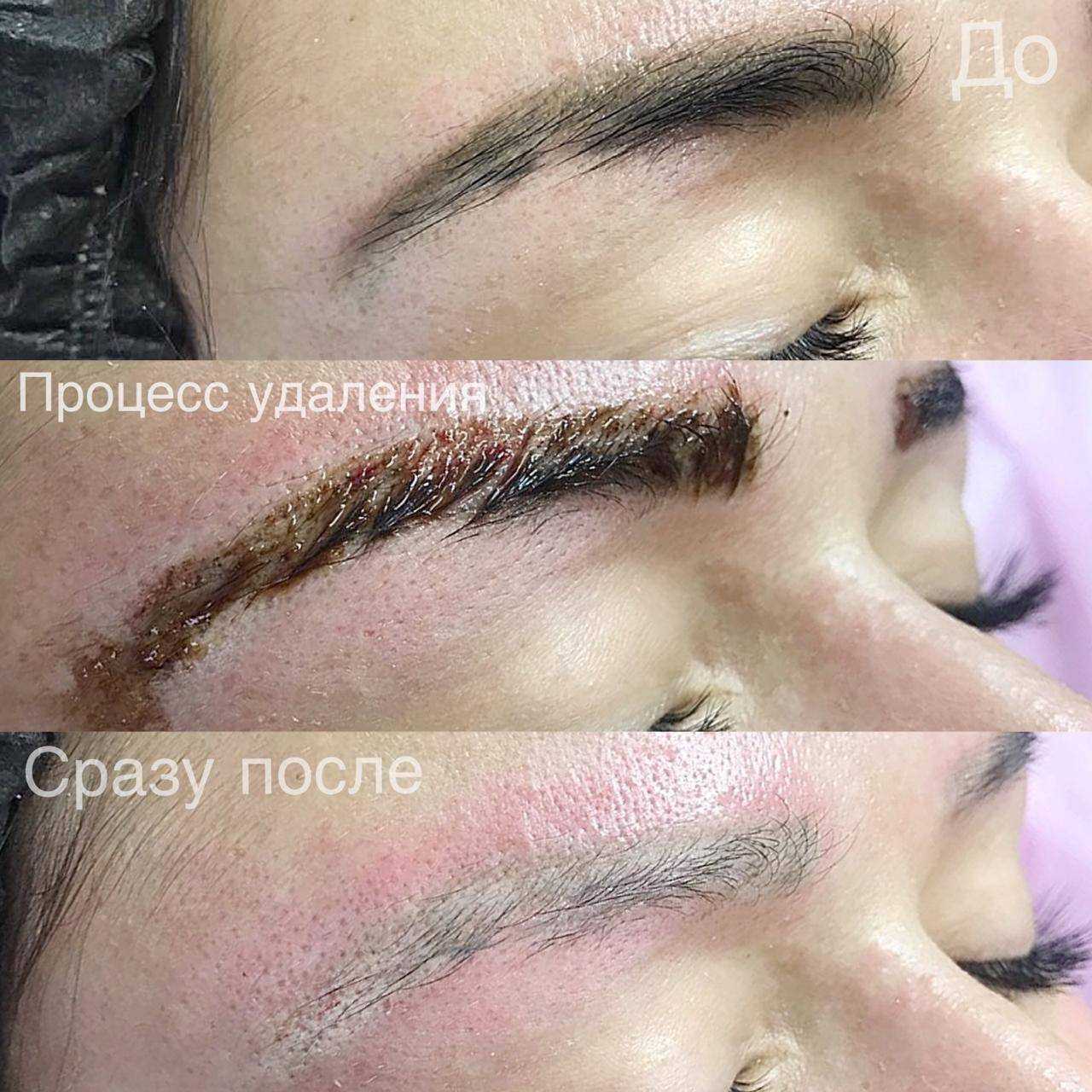 Чем лучше вывести татуировку, чтобы не остался шрам? | атлантик