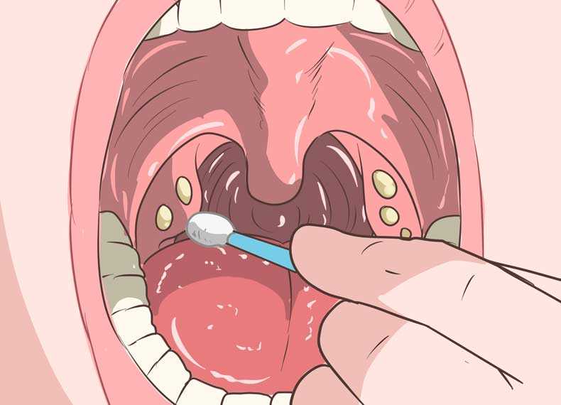 Como quitar los tonsilolitos