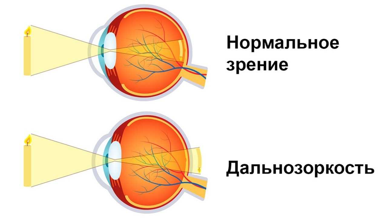 Из за чего падает зрение. Дальнозоркость. Строение глаза дальнозоркость. Нормальное зрение и дальнозоркость. Дальнозоркость рисунок.