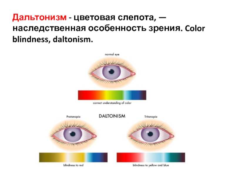Ген общей цветовой слепоты. Дальтонизм причины проявления Тип наследования. Нарушения цветового зрения - дальтонизм. Дальтонизм это генная болезнь. Дальтонизм 1 степени.